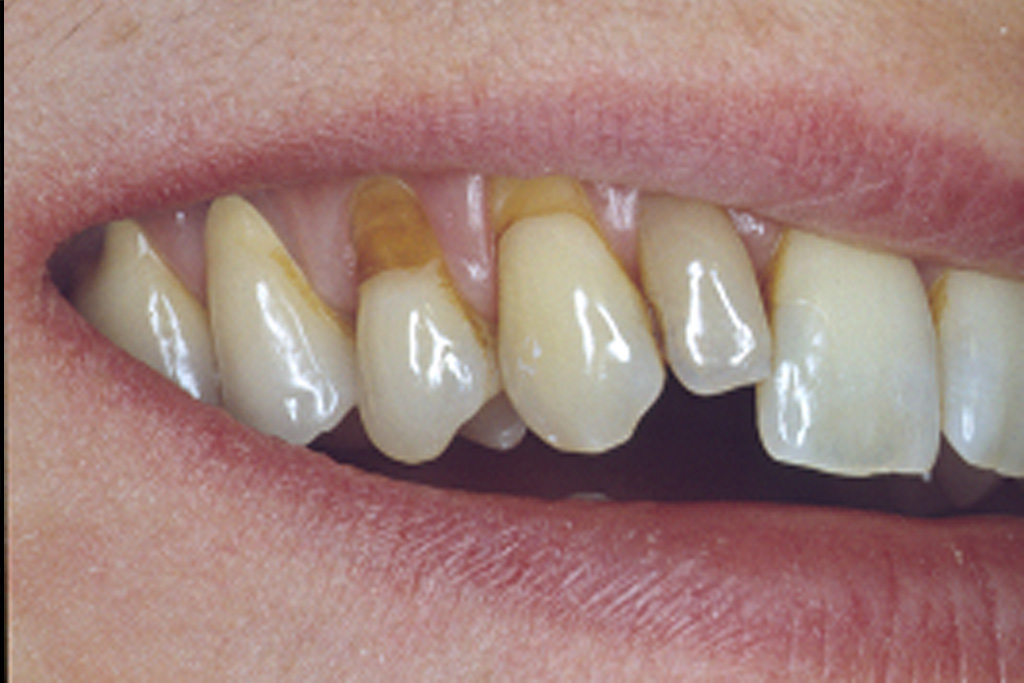 Abb. 1: Ausgangsbefund der Zähne 13 und 14 mit Karies im Zahnhalsbereich 