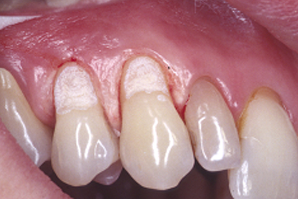 Abb.2: ER:YAG-Laser-Präparation im Zahnhalsbereich der Zähne 13 und 14