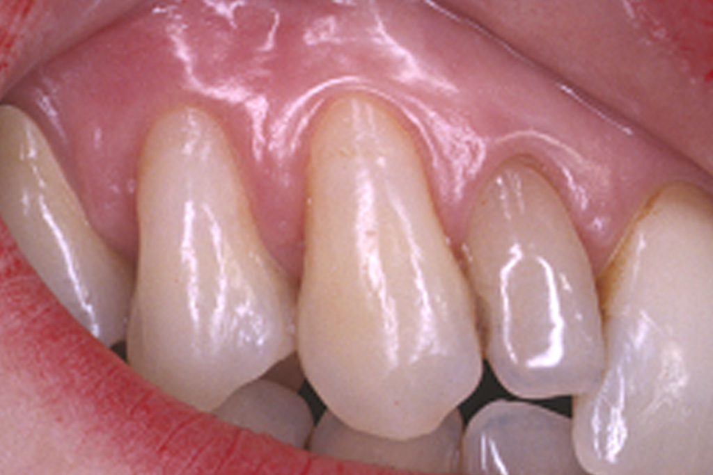 Abb.4: Nahaufnahme der Klasse-V-Füllungen der Zähne 13 und 14