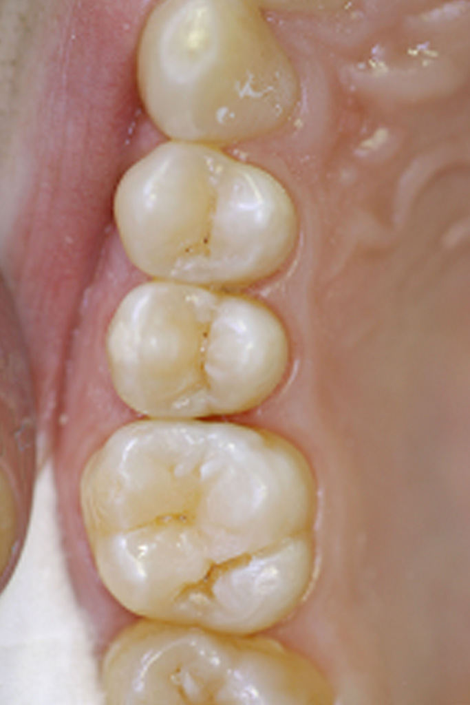 Ausgangsbefund: kariös veränderte Zahnfissuren