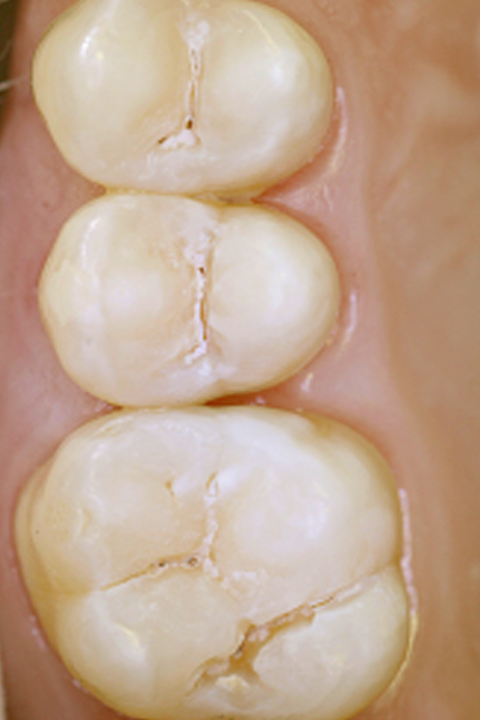Laserbehandlung: Reinigung und Sterilisation der Fissuren mit dem Laser
