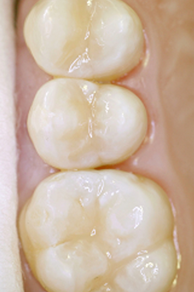 Ergebnis: Versiegelung der sterilisierten Fissuren