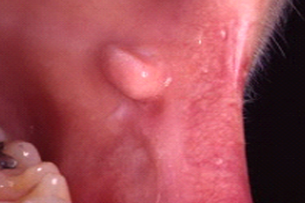 Ausgangsbefund: Fibrom: Weichteiltumor im linken Mundwinkel