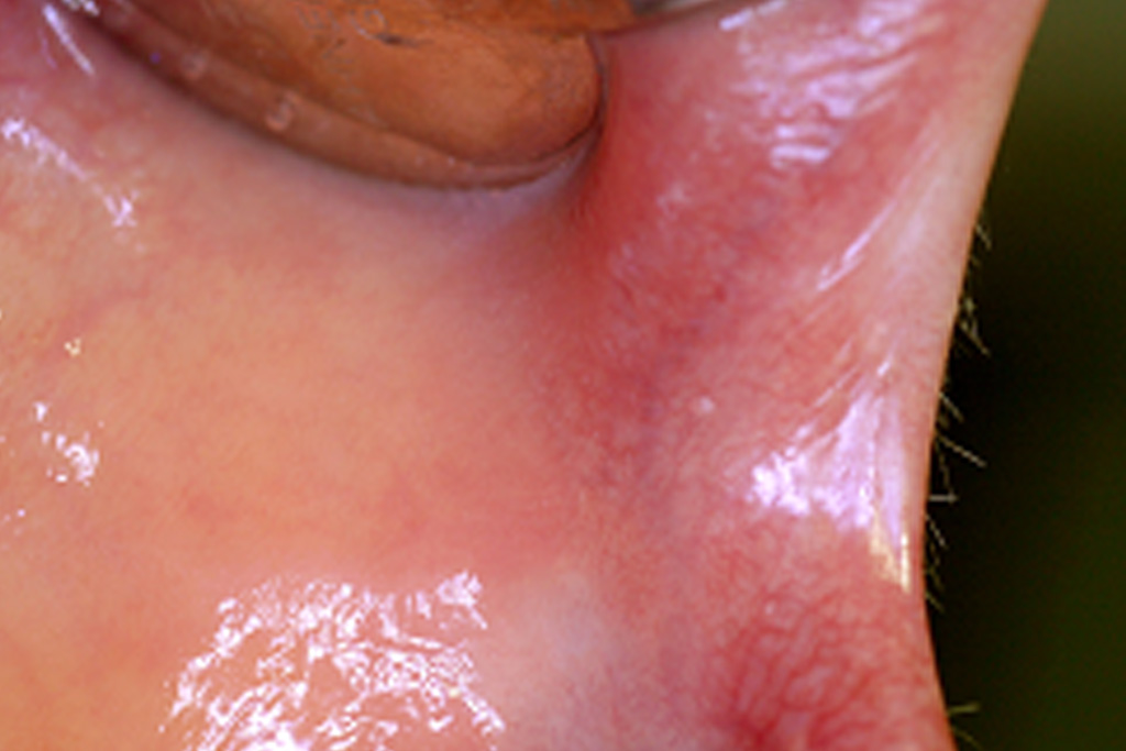 Schlußbefund 10 Tage nach Laserbehandlung