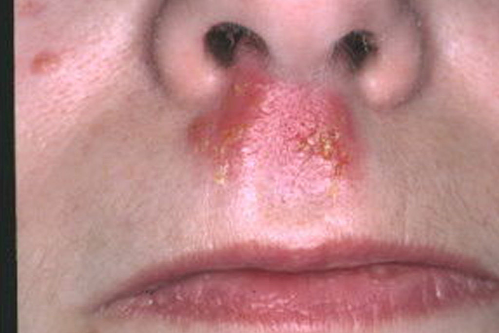 Ausgangsbefund: Typische Herpes simplex Effloreszenz im Frühstadium