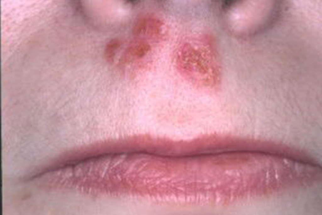 Zustand 3 Tage nach Bestrahlung mit dem Nd-YAG-Laser