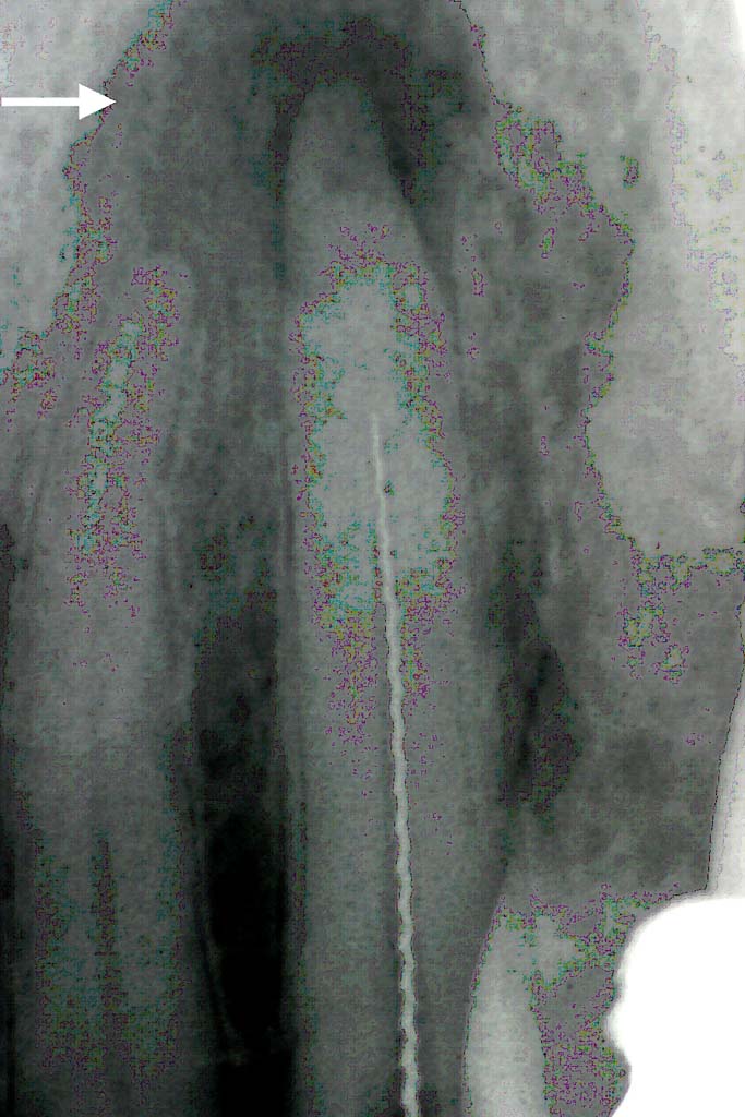 Ausgangsbefund: Deutlich erkennbarer Entzündungsherd an der Wurzelspitze eines Eckzahnes