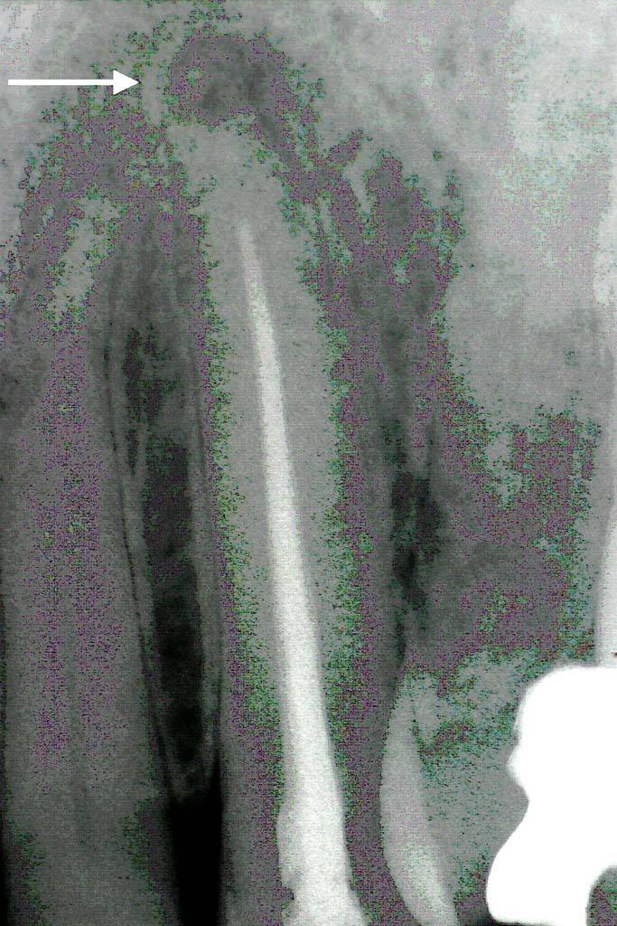 Schlussbefund: 11 Monate nach der Laserbehandlung zeigt sich eine vollständige Abheilung an der Wurzelspitze des Eckzahnes ohne ! Wurzelspitzenresektion 