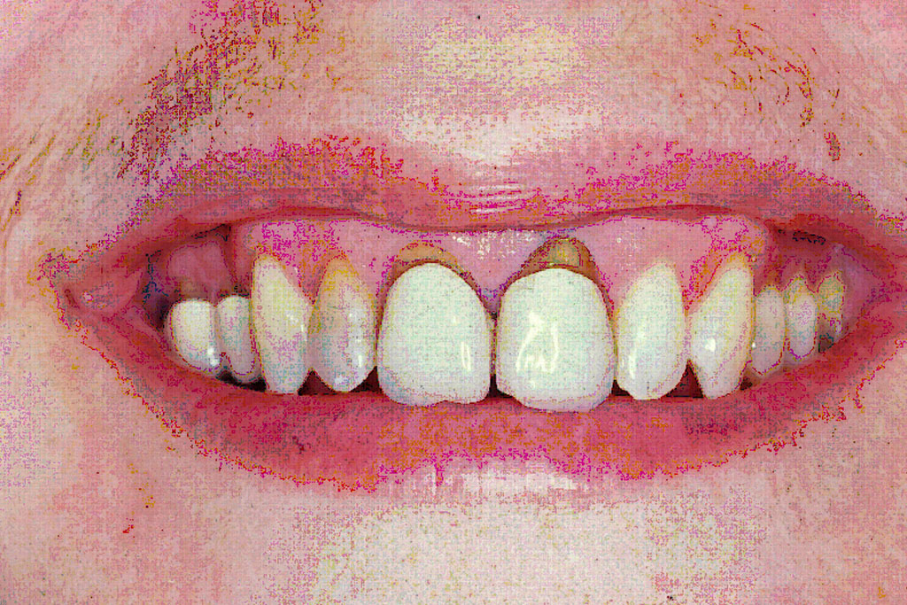 Abb. 1 : unerwünschte Probleme nach Einsetzen der Kronen: Zahnfleischrückgang am Kronenrand und Zahnstumpfverfärbung, sichtbarwerden der Kronenränder